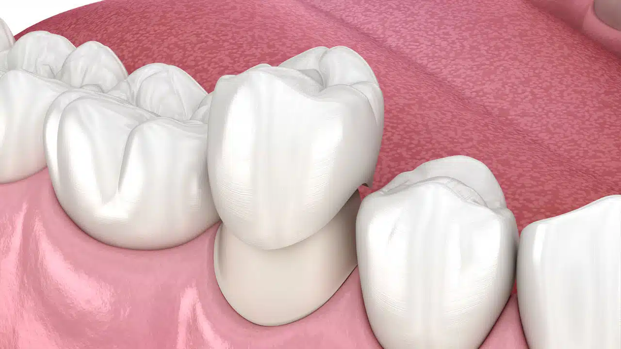 Graphic showing a dental crown
