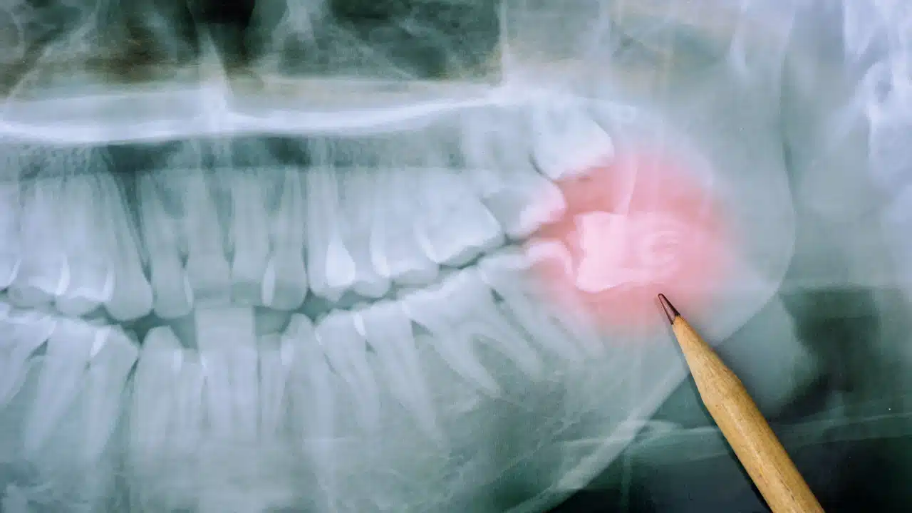X-ray image of wisdom tooth