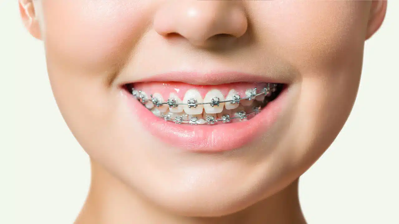 Close up of a girl with braces smiling at camera