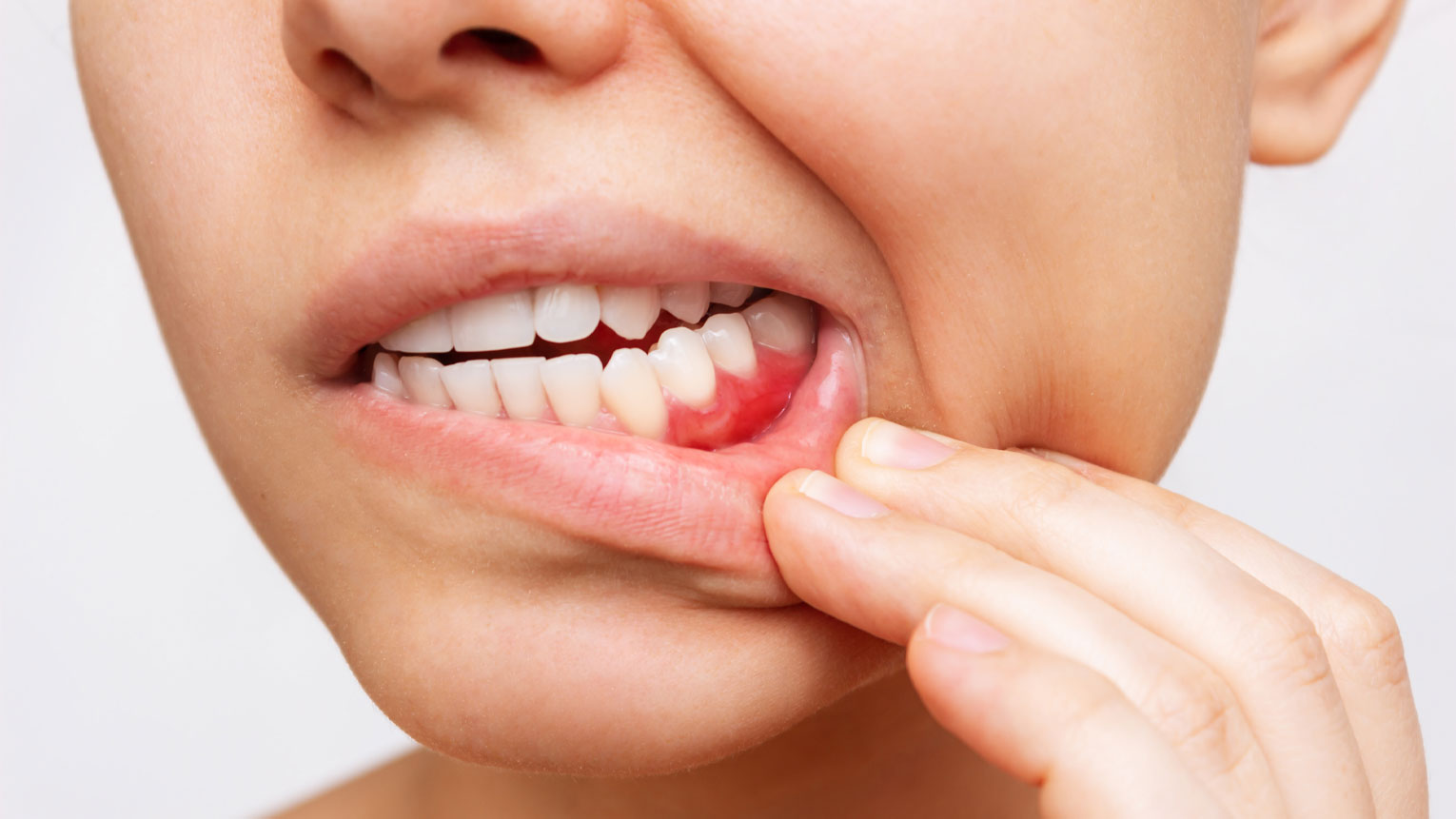 Gum Disease Prevention: Tips for a Healthy Mouth